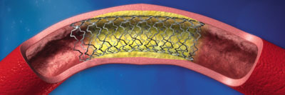 Stent placed to hold open artery